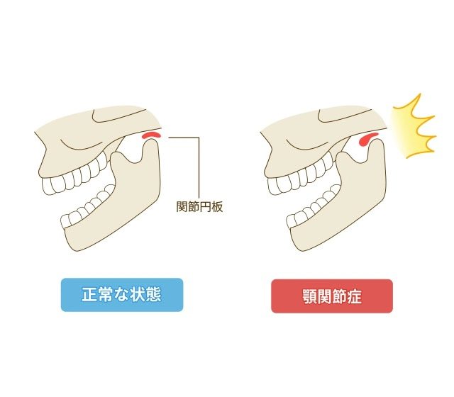 顎関節症とは